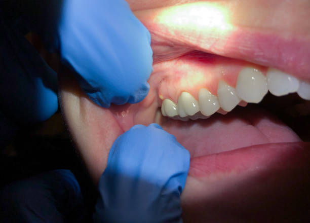 Best Emergency Denture Repair in Stepney, CT